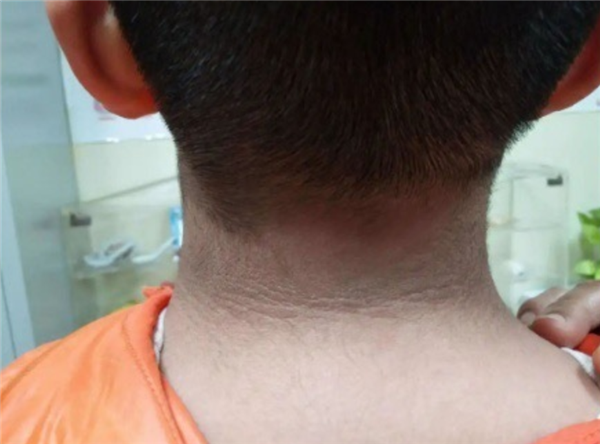 13岁男孩脖子洗不干净确诊黑棘皮病:胰岛素失控所致