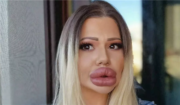 女子为拥有全球最大嘴唇花18万整形：看牙时惨遭医生拒绝