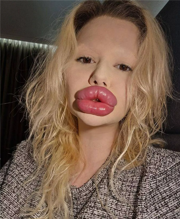 女子为拥有全球最大嘴唇花18万整形：看牙时惨遭医生拒绝