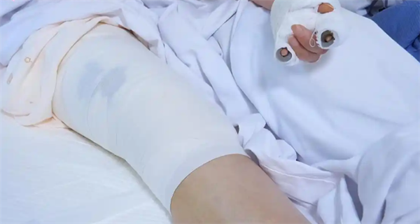 贵阳阿姨河道捡到漂亮石头 竟自燃导致自己四肢烧伤