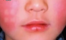 日本“苹果病”流行达到历史顶点:从双颊开始形成网状红斑 !