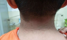 13岁男孩脖子洗不干净确诊黑棘皮病：胰岛素失控所致